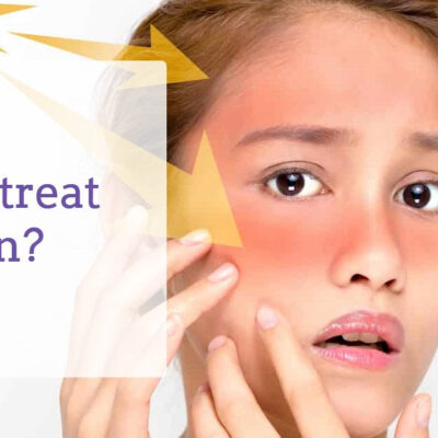 Remove sunburn from face quickly