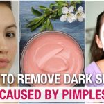 natural remedy to remove dark spots caused by pimples