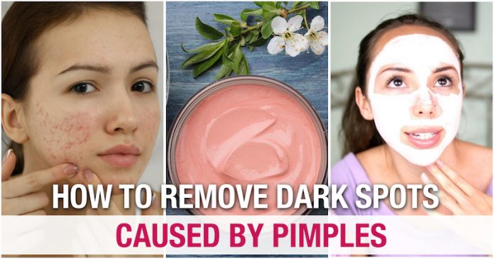 natural remedy to remove dark spots caused by pimples