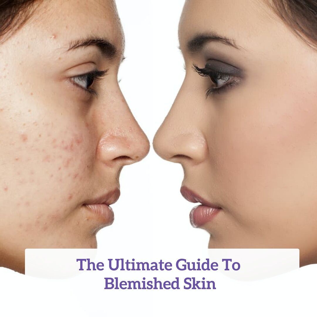 Get blemish free skin in 10 days