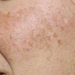 Safe and fastest ways to reduce melasma