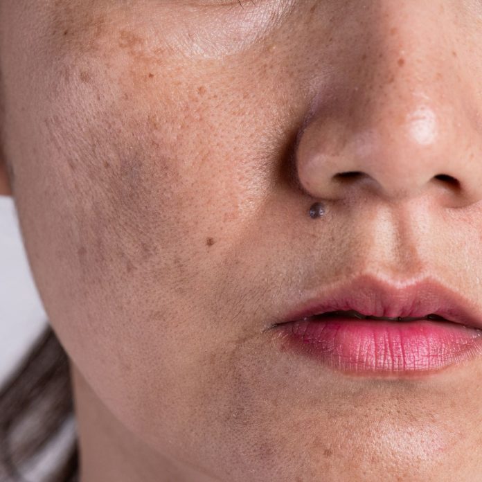How I Reduce Blemishes Pigmentation Spots In A Week