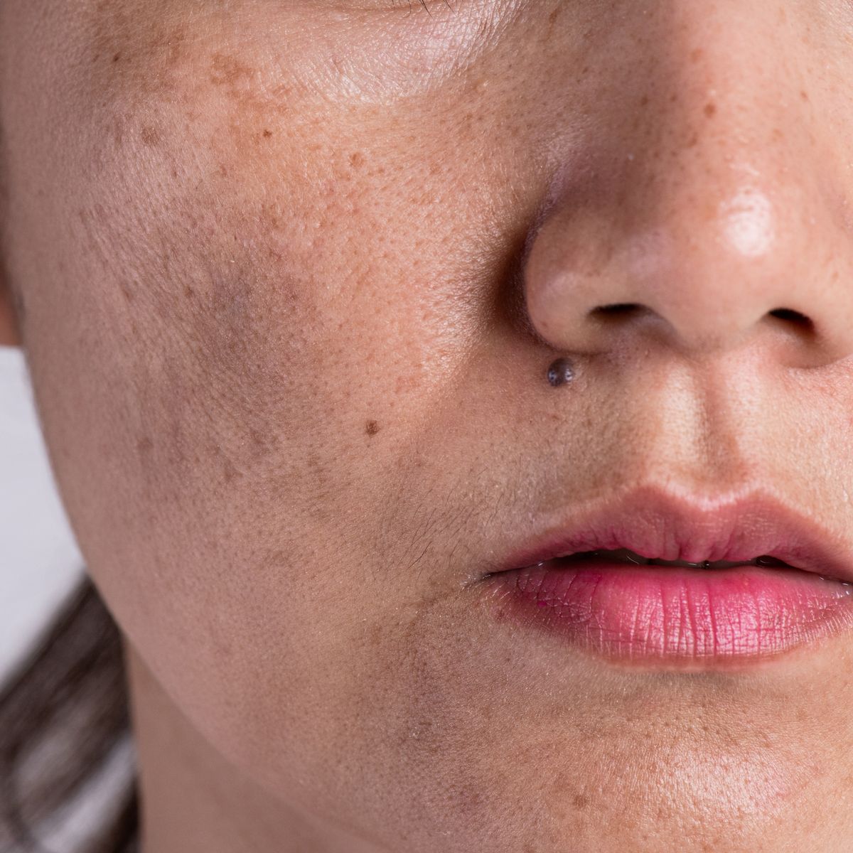 How I recue blemishes, spots and pigmentation form my face
