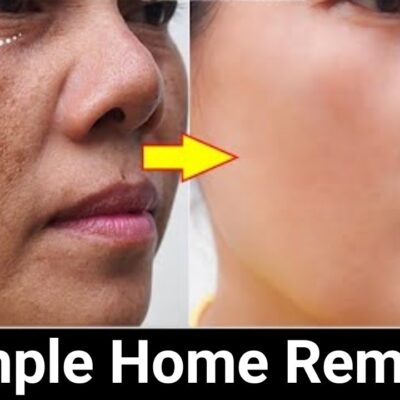Powerful home remedies that effectively works to remove pigmentation