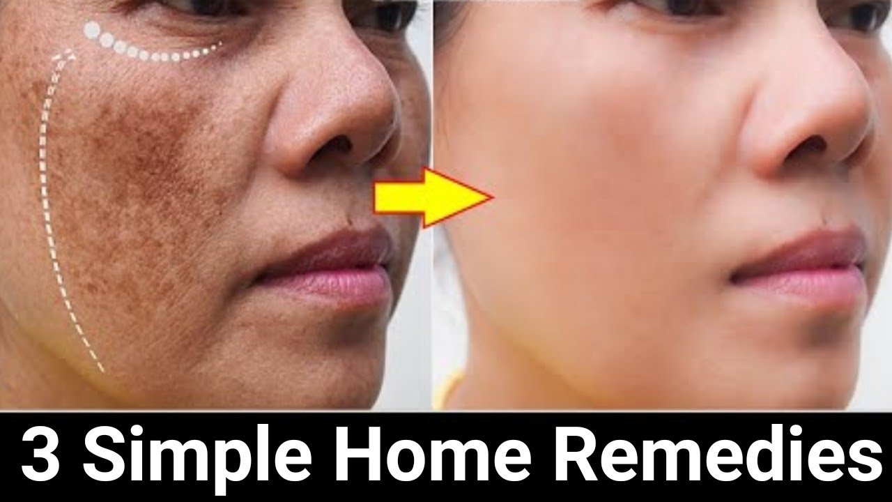 Powerful home remedies that effectively works to remove pigmentation