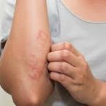 Eczema VS atopic dermatitis
