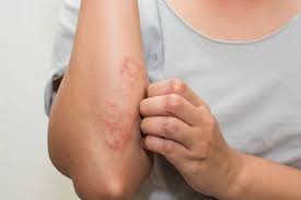 Eczema VS atopic dermatitis