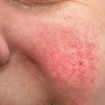 20 Home remedies to get rid of dry scaly skin