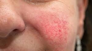 20 Home remedies to get rid of dry scaly skin