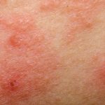 All about eczema you need to know