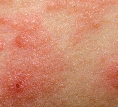 All about eczema you need to know