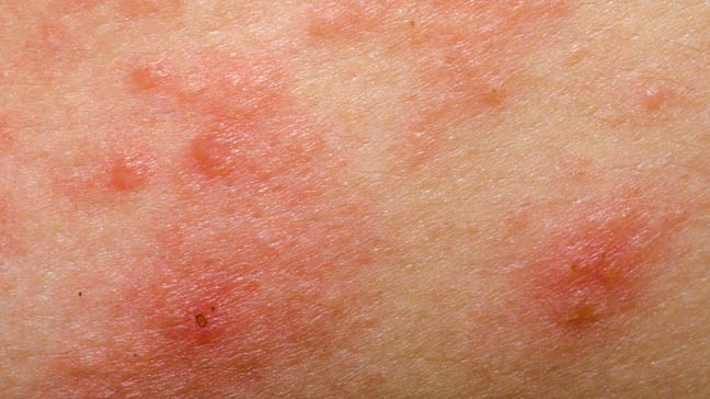 All about eczema you need to know