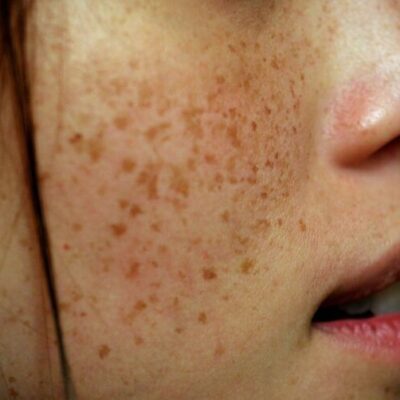 How to remove freckles permanently