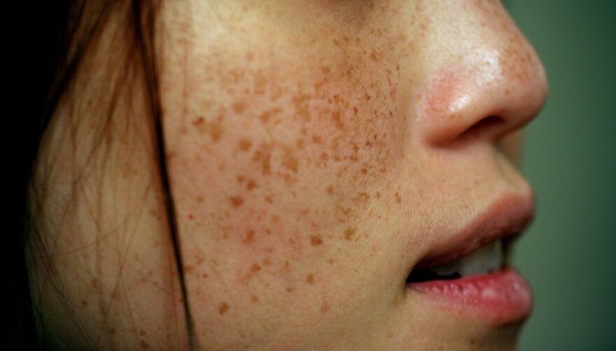How to remove freckles permanently