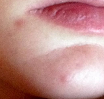 Blind pimple on chin
