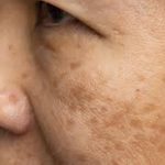 hOME REMEDIES TO CURE MELASMA