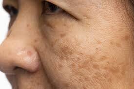 hOME REMEDIES TO CURE MELASMA