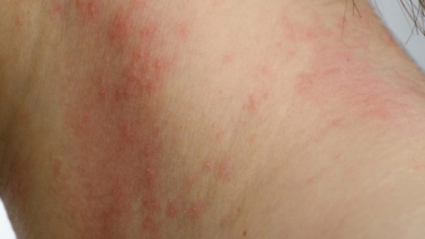 Contact Dermatitis Causes Types Symptoms And Prevention 
