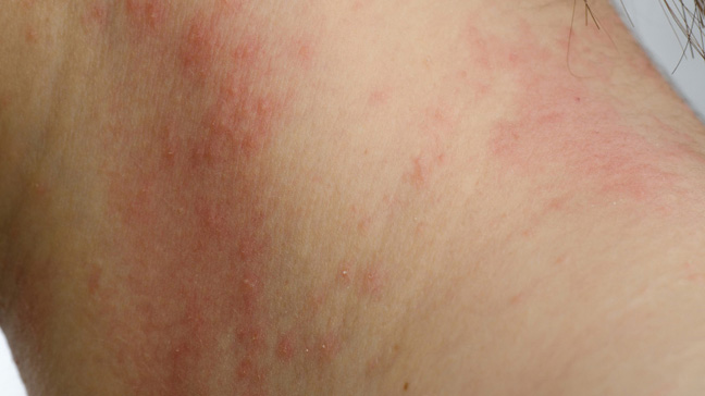 Picture of contact dermatitis