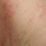 Types of contact dermatitis