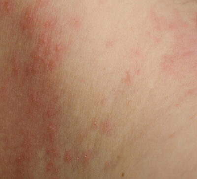 Types of contact dermatitis