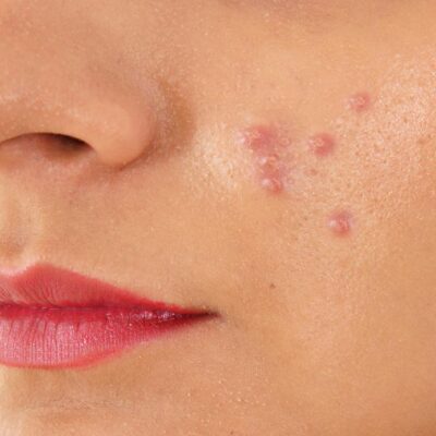Treat blind pimple naturally at home