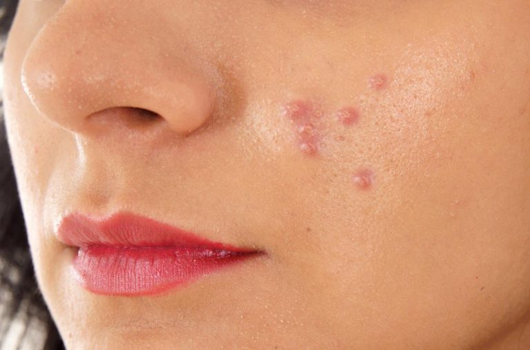 Treat blind pimple naturally at home