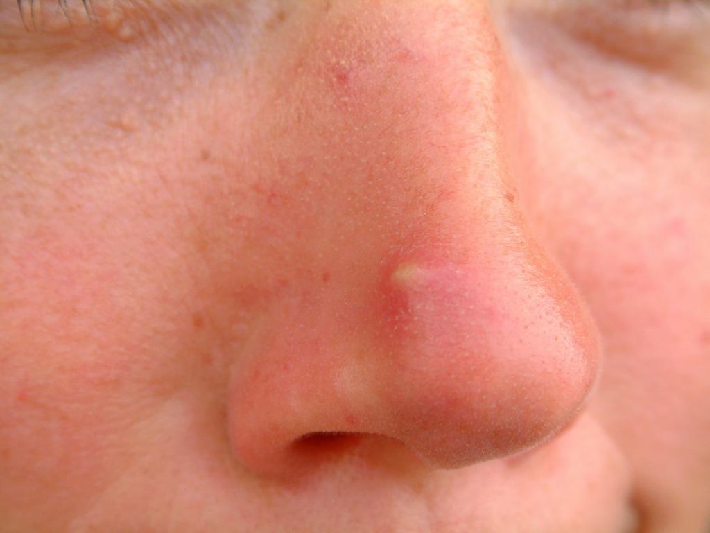 Blind pimple on nose