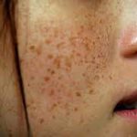 Remove brown spots, sun spots, liver spots, age spots naturally and permanently at home