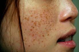 Remove brown spots, sun spots, liver spots, age spots naturally and permanently at home
