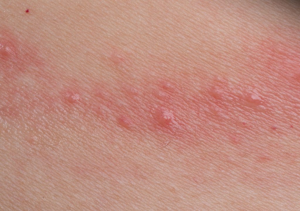 Picture of contact dermatitis