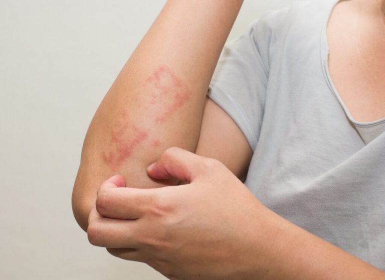 Contact Dermatitis Causes Types Symptoms And Prevention 