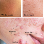 How to remove dark spots and pimples on face
