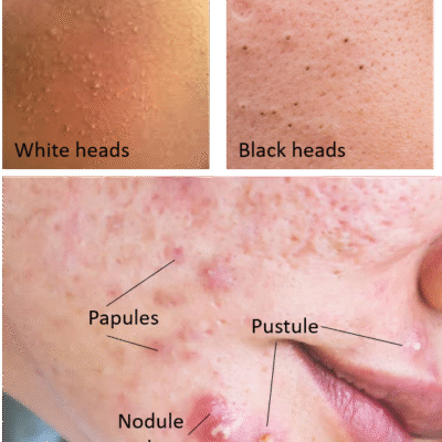 How to remove dark spots and pimples on face