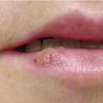 sun blister on lips