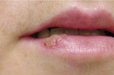 sun blister on lips