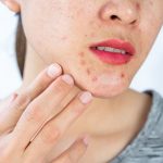 All about pimples on chin