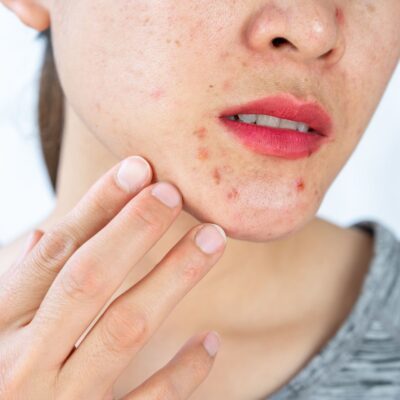 All about pimples on chin