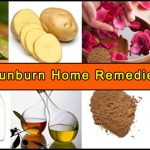 Home Remedies For Sunburn that will ease pain, itching, and redness in no time.