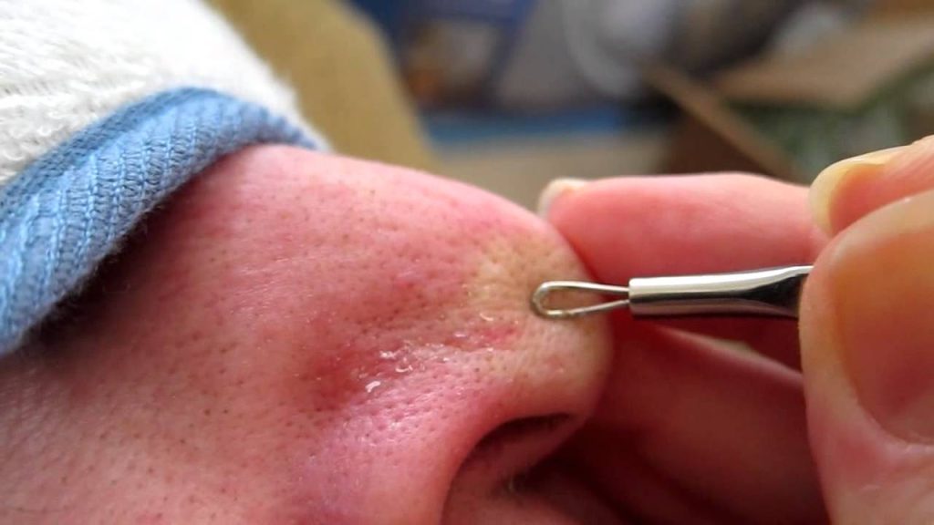 Extracting blackheads and whiteheads