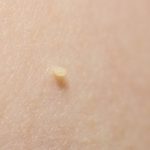 Skin tags are small, soft, painless, non-cancerous growth that usually forms within the skin folds