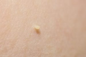 Skin tags are small, soft, painless, non-cancerous growth that usually forms within the skin folds