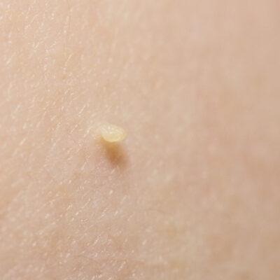 Skin tags are small, soft, painless, non-cancerous growth that usually forms within the skin folds