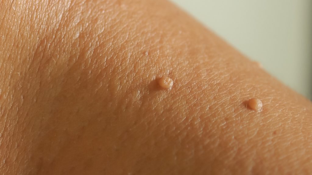 Skin tags are small, soft, painless, non-cancerous growth that usually forms within the skin folds such as neck, armpits, groin area and eyelids. 