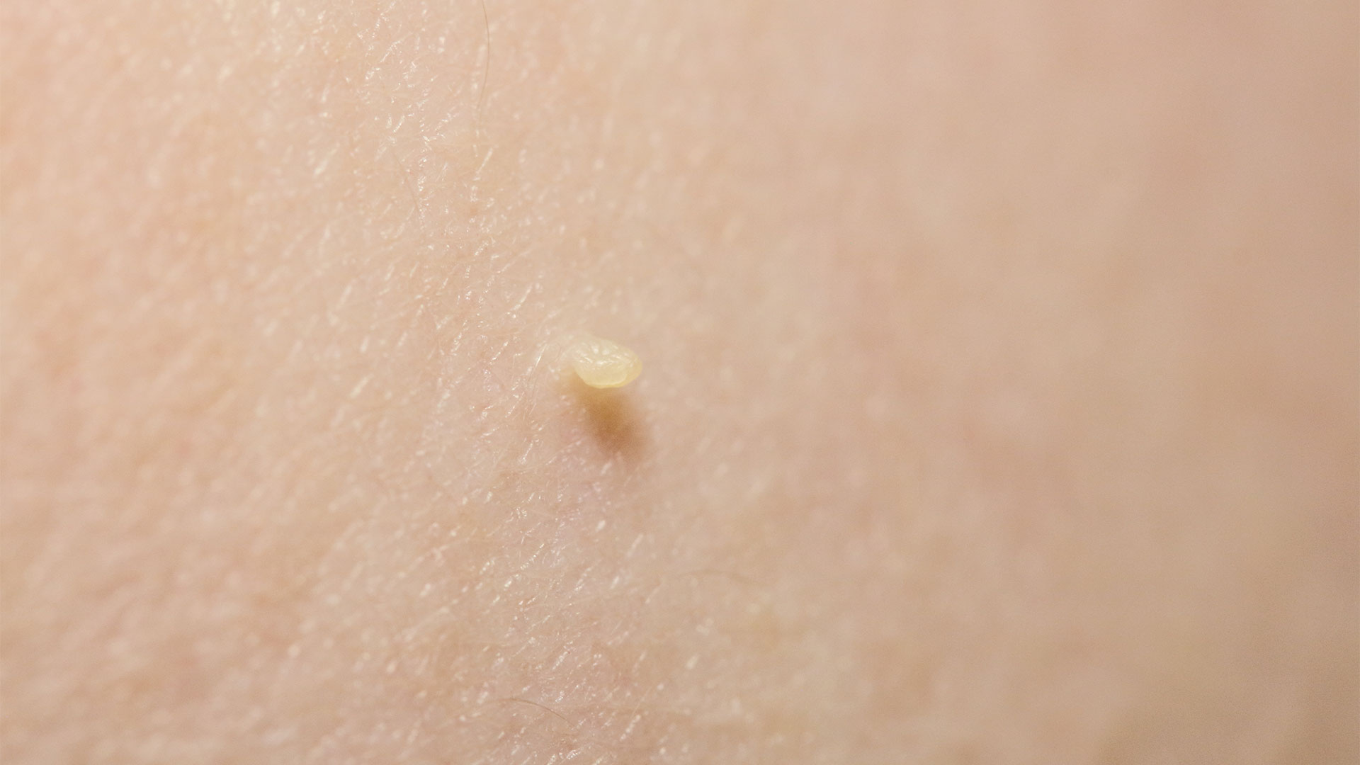 Skin tags are small, soft, painless, non-cancerous growth that usually forms within the skin folds