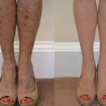 Spots on legs