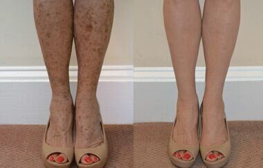 Spots on legs