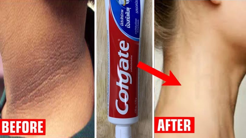 Combination of toothpaste and vaseline helps to remove dark body parts