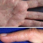 Dyshidrotic-eczema: causes, symptoms, treatment and prevention