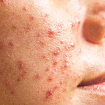 Causes, symptoms, treatment, prevention and skin care routine to get rid of cystic acne